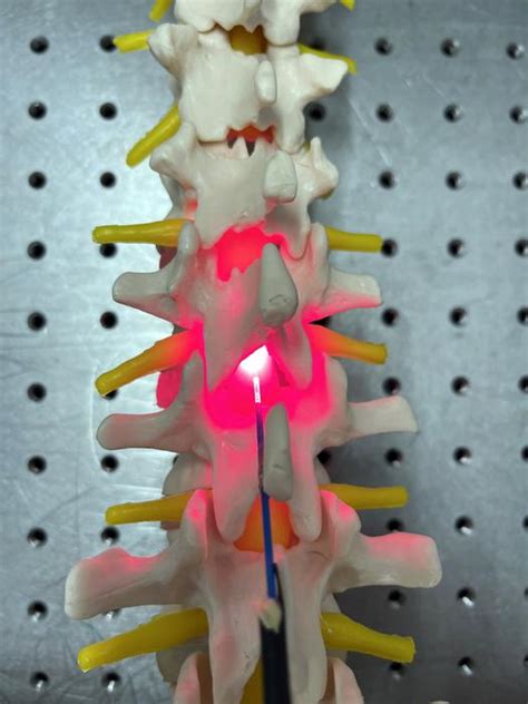 spinal cord injury - Industry Tap