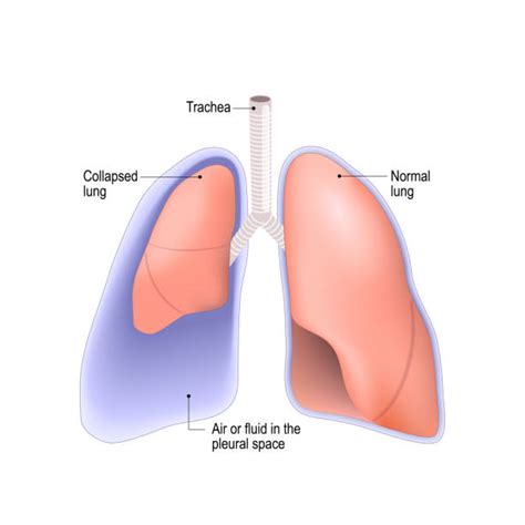 Pleural Thickening Symptoms, Causes And Treatment, 48% OFF