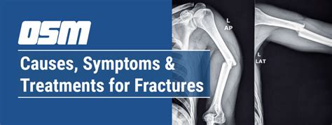 Causes, Symptoms & Treatments for Fractures - Orthopedic & Sports Medicine