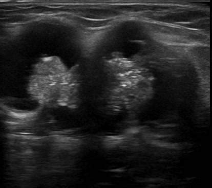 Head and Neck | 4.4 Lymph nodes : Case 4.4.2 Malignant lymph nodes ...