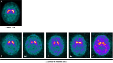 Frontiers Practical Use Of DAT SPECT Imaging In Diagnosing Dementia