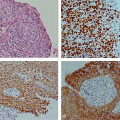 Hande And Immunohistochemical Staining Of Ki67 P16 And Ck17 In Cin3 A Download Scientific