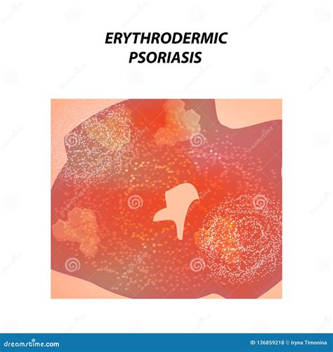 Erythrodermic Psoriasis Eczema Dermatitis Skin Disease Psoriasis