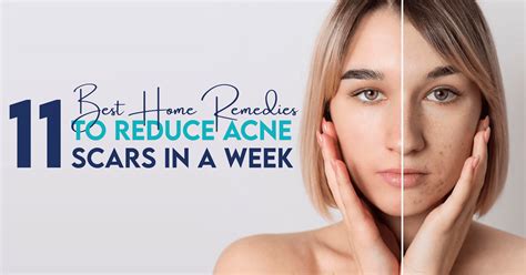 11besthomeremediestoreduceacnescarsinaweekpngv1732886119
