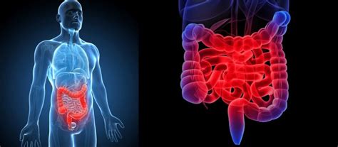 Nieswoiste Zapalenie Jelit Diagnostyka I Leczenie Transplantacja Org Pl