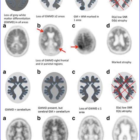 (A) Typical features of a positive amyloid PET scan -"tree-in-bloom"... | Download Scientific ...