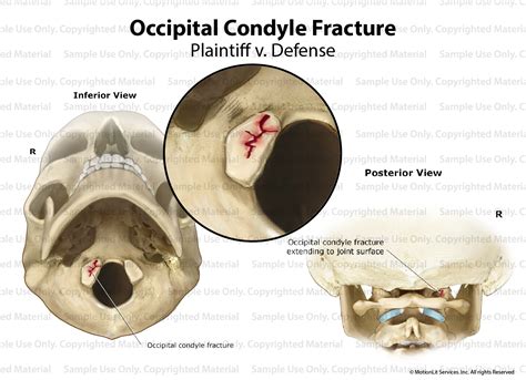 Occipital Condyle Fracture - MotionLit