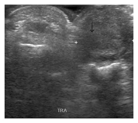 Giant Cell Tumor Of Tendon Sheath A 20 Year Old Female Presented With Download Scientific