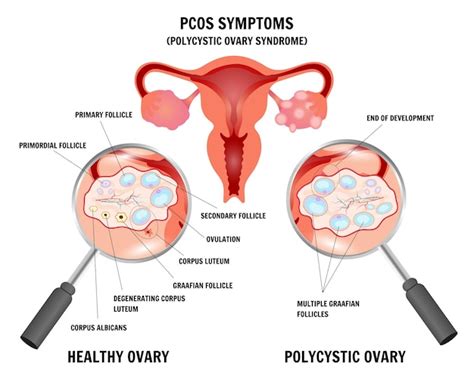 Premium Vector Medical Infographic Gynecology Disease Polycystic