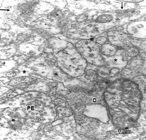 Cystic Craniopharyngioma Right Frontal Cortex Edematous Neuropil