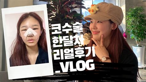 유원 일 코끝 코성형vlog 내돈주고성형한 리얼코성형후기 D 1부터 D30까지 리얼 코성형리뷰 최근 답변 160개