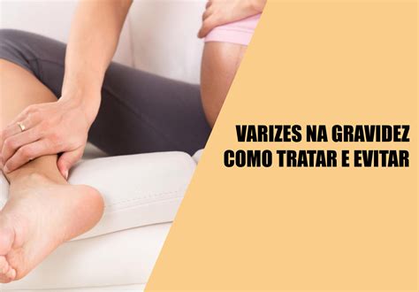 Como Acabar As Varizes Na Gravidez Confira As Dicas