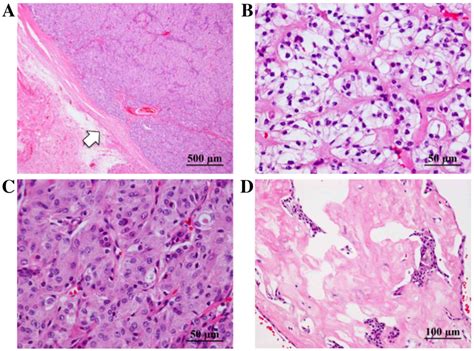 Afip Grading Of Mucoepidermoid Carcinoma An Analysis Of Bcl 2 And Bax Markers Expression In