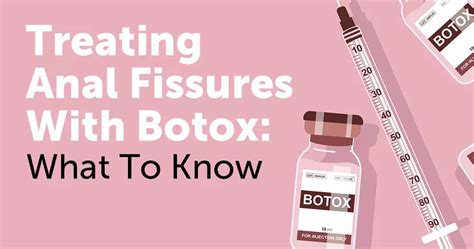 Treating Anal Fissures With Botox Side Effects And More