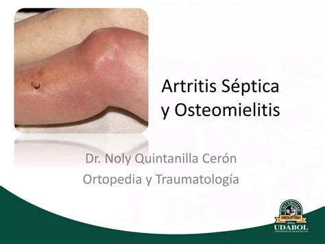 Artritis S Ptica Y Osteomielitis Pptx