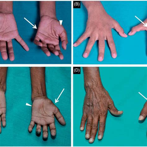 (PDF) Reverse split hand syndrome: Dissociated intrinsic hand muscle ...