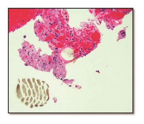 A Rectal Fna Biopsy Hande 20x With Strips Of Benign Colonic Mucosa