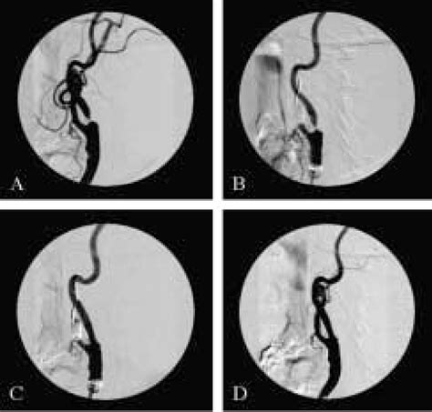 Angiographic Images Of Carotid Angioplasty And Stenting With Reversal