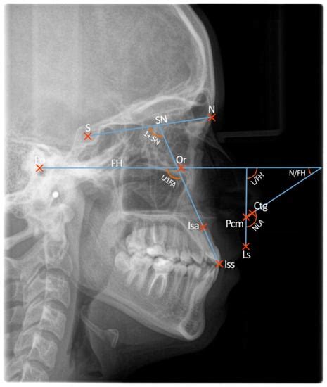 Relationship Between Selected Cephalometric Parameters Nasolabial