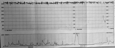 Pathophysiological Interpretation Of Fetal Heart Rate Tracings In Clinical Practice American