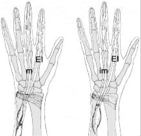 Extensor Indicis Muscle