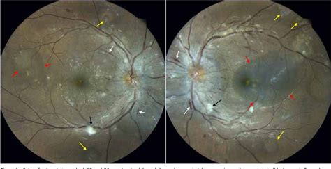 Figure From A Tale Of Hypertensive Retinopathy With Choroidopathy And