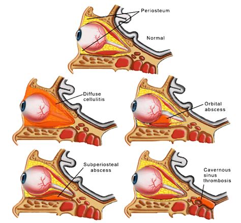 Orbital Cellulitis Abscess Orbital Cellulitis Abscess Cellulitis Orbital Infection