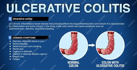 Infografía De Los Síntomas De La Colitis Ulcerosa Vector Gratis