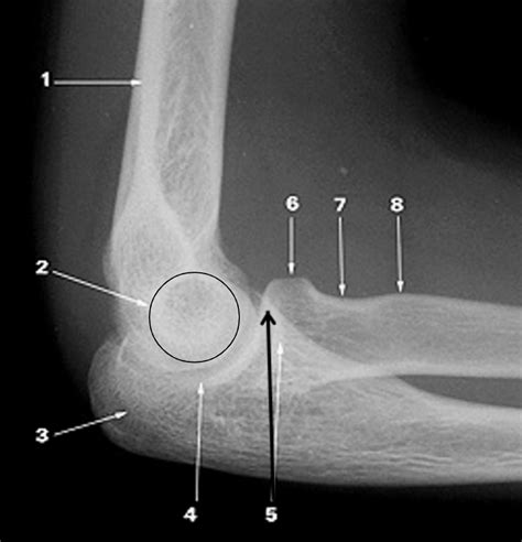 Lateral Elbow Radiograph Diagram Quizlet