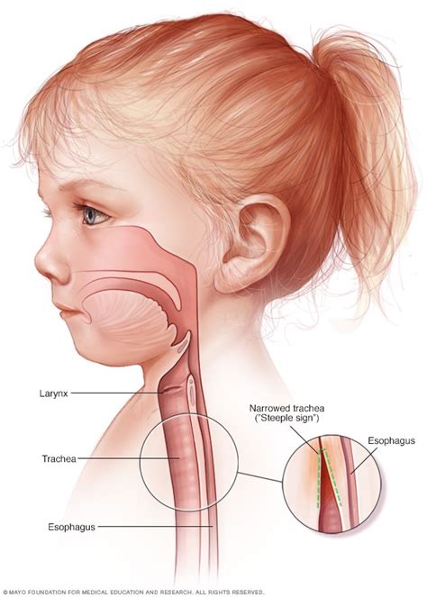 Croup - Symptoms and causes - Mayo Clinic