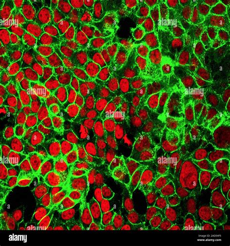 Les Cellules Du Cancer Du C Lon La Lumi Re De Fluorescence De