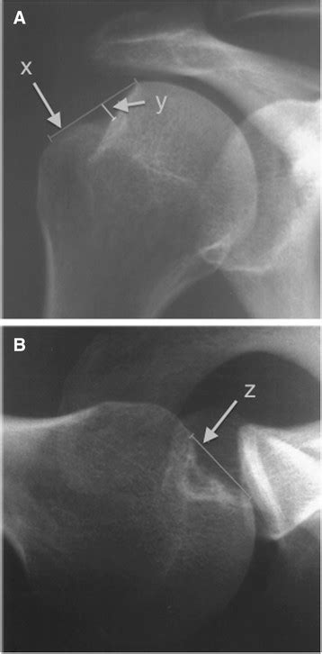 Hill Sachs Quotient A True Ap X Ray Of The Humerus With The Shoulder Download Scientific