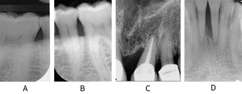 Periodontitis Prevention And Treatment Of Periodontal Diseases In