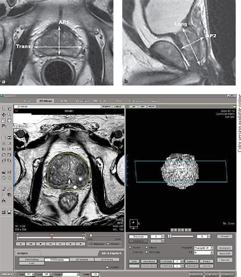 Figure 3 From Comparison Of Prostate Volume Measured By Transrectal