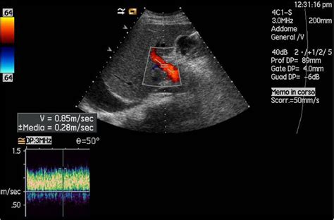 Figure 1 From Role Of Colour Doppler Ultrasonography Cdus In