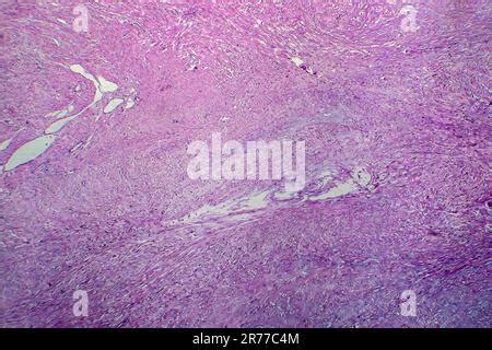 Les Fibromes Ut Rins La Lumi Re Microphotographie Lm D Une Section