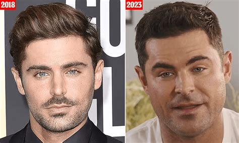 What Happened To Zac Efron Face