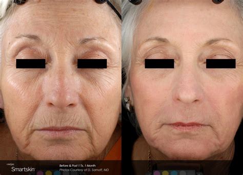 Smartskin C02 Fractional Laser Resurfacing Specialist Lakeland Fl North County Dermatology