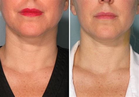 Belotero Dermal Filler For Saggy Necks Dermal Fillers Botox Fillers