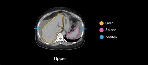 Abdominal Ct Peritoneal Cavity • Litfl • Radiology Library