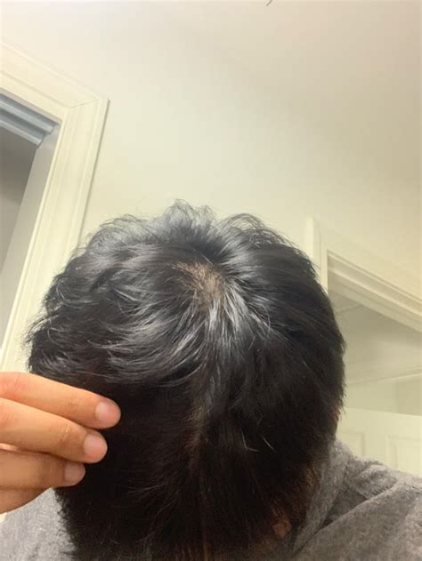 Diffuse thinning? : r/Hairloss