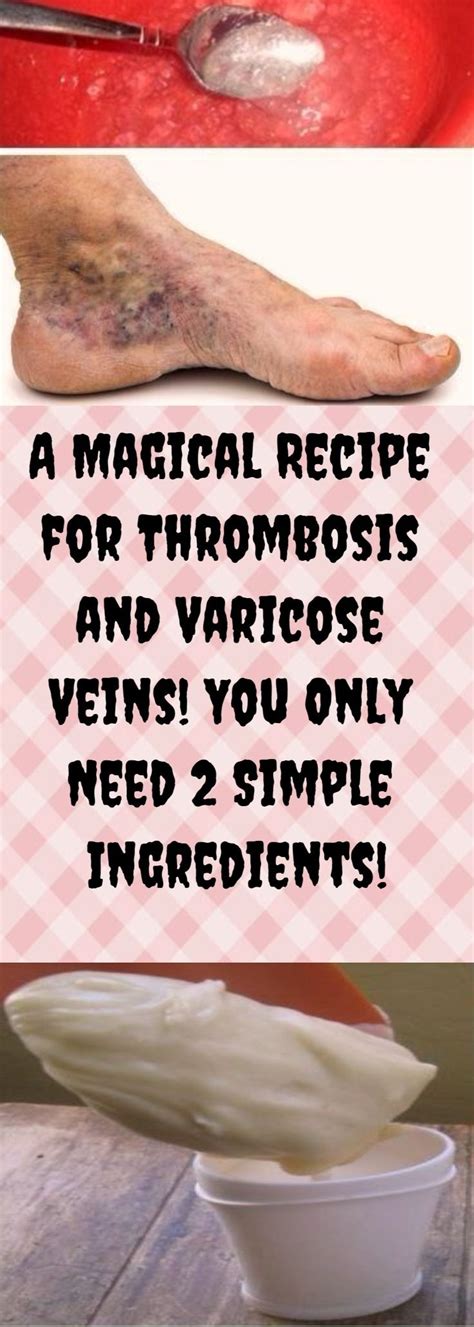 A Magical Recipe For Thrombosis And Varicose Veins You Only Need 2 Simple Ingredients