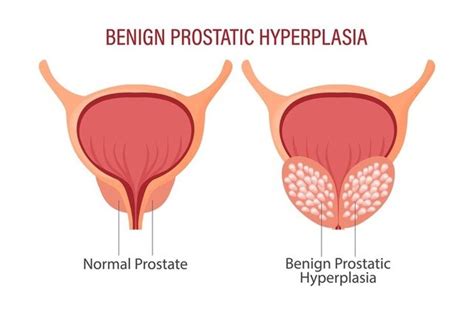 A Growing Concern: Benign Prostatic Hyperplasia Explained ...