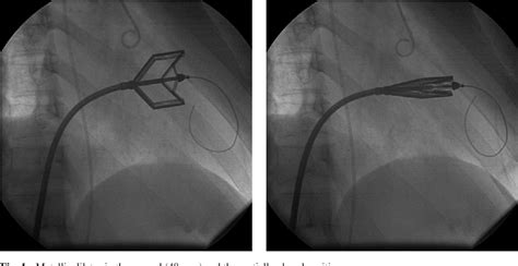 Figure 1 From Experience Of Percutaneous Mechanical Mitral