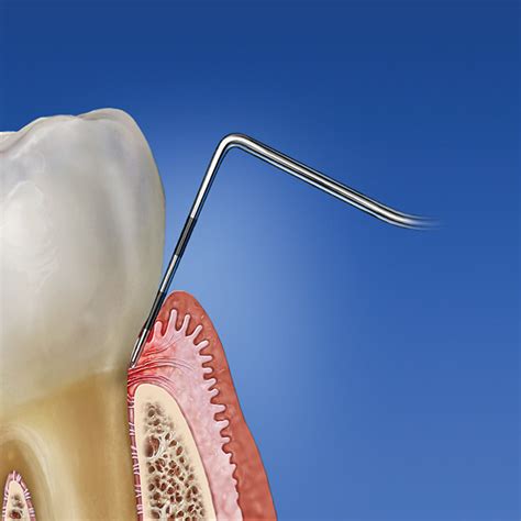 Gingival Sulcus Depth