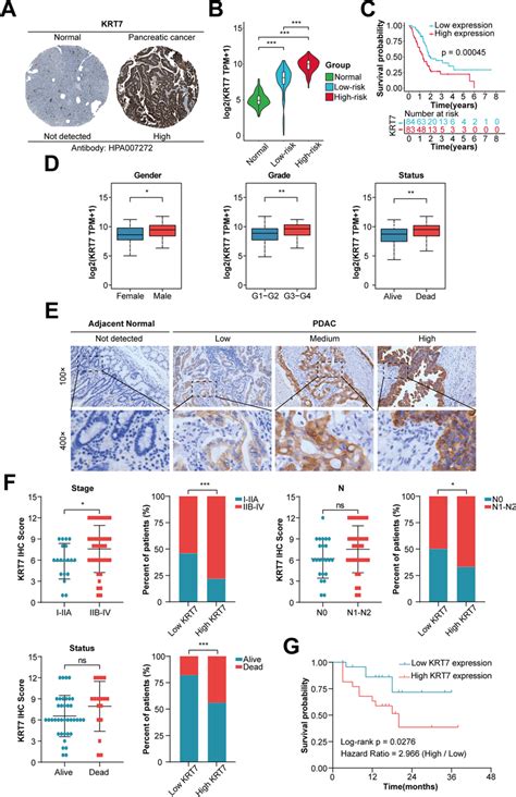 Validation Of Krt High Expression In Pc And Its Association With Poor