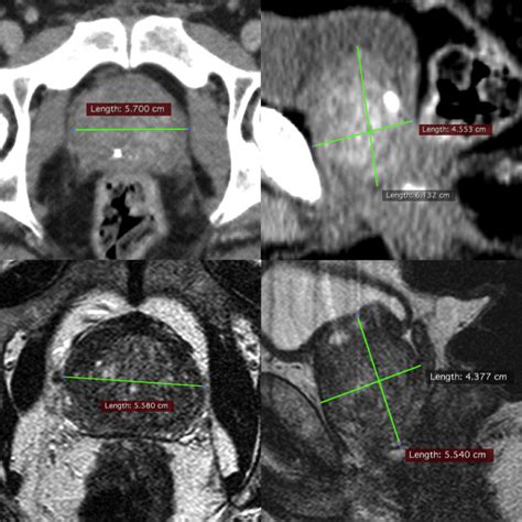 CT v MRI. Comparison imaging of prostate volume measurements using CT ...