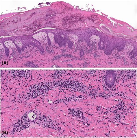 A B Biopsy Specimen Showing A Marked Papillary Dermis Edema With A