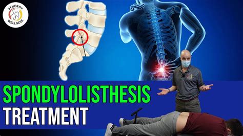 Spondylolisthesis Treatment - YouTube