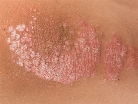 Scaling skin: Pictures, causes, treatment, and prevention